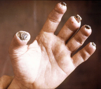 A photo of a hand post-frostbite. The fingertips of each finger are missing.