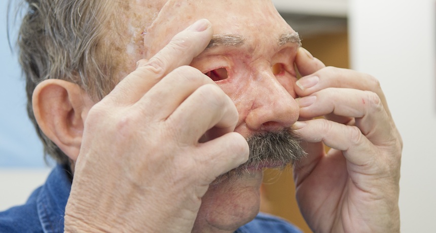 prosthetic face