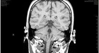This is a magnetic resonance image of the inside of someone’s head. MRI can show the brain in beautiful detail.