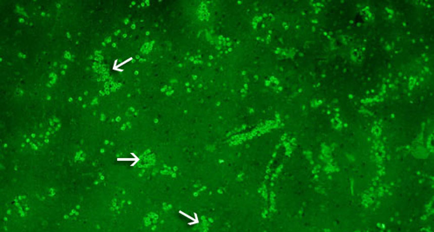 This section of brain came from a patient infected with N. fowleri. A fluorescent stain highlights, under the microscope, the tiny amoebas as bright green dots. Arrows point to some large clusters of them.