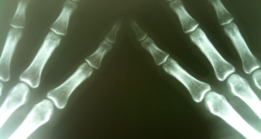 X-rays allow us to see our bones in wonderful detail. But too much exposure can be dangerous. X-rays are a carcinogen, meaning that they can cause cancer.