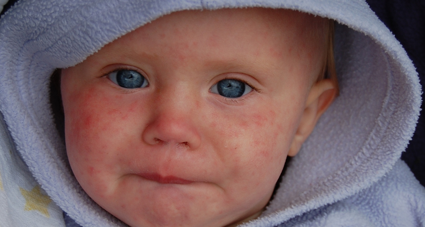 Measles baby