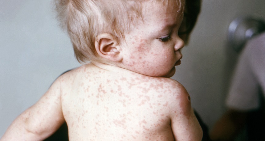 measles baby