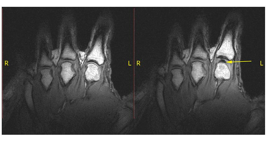 A knuckle at rest (left) pops when pulled. The sound comes from a bubble (right, yellow arrow) opening up in the joint.