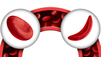 a normal "doughnut" red blood cell on the left in a circle and a sickle celled blood cell on the right in a circle. Both circles are on top of an illustration of an upside-down U-bent blood vessel