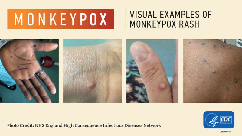 a series of four pictures showing monkeypox rashes on different skin colors