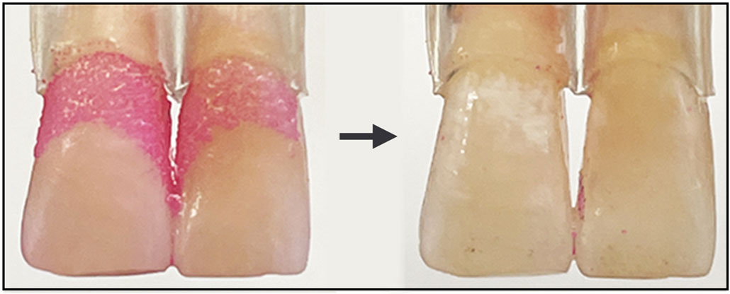 two pairs of teeth one with red dyed plaque before brushing with the robotic tooth-cleaner and one without plaque after cleaning