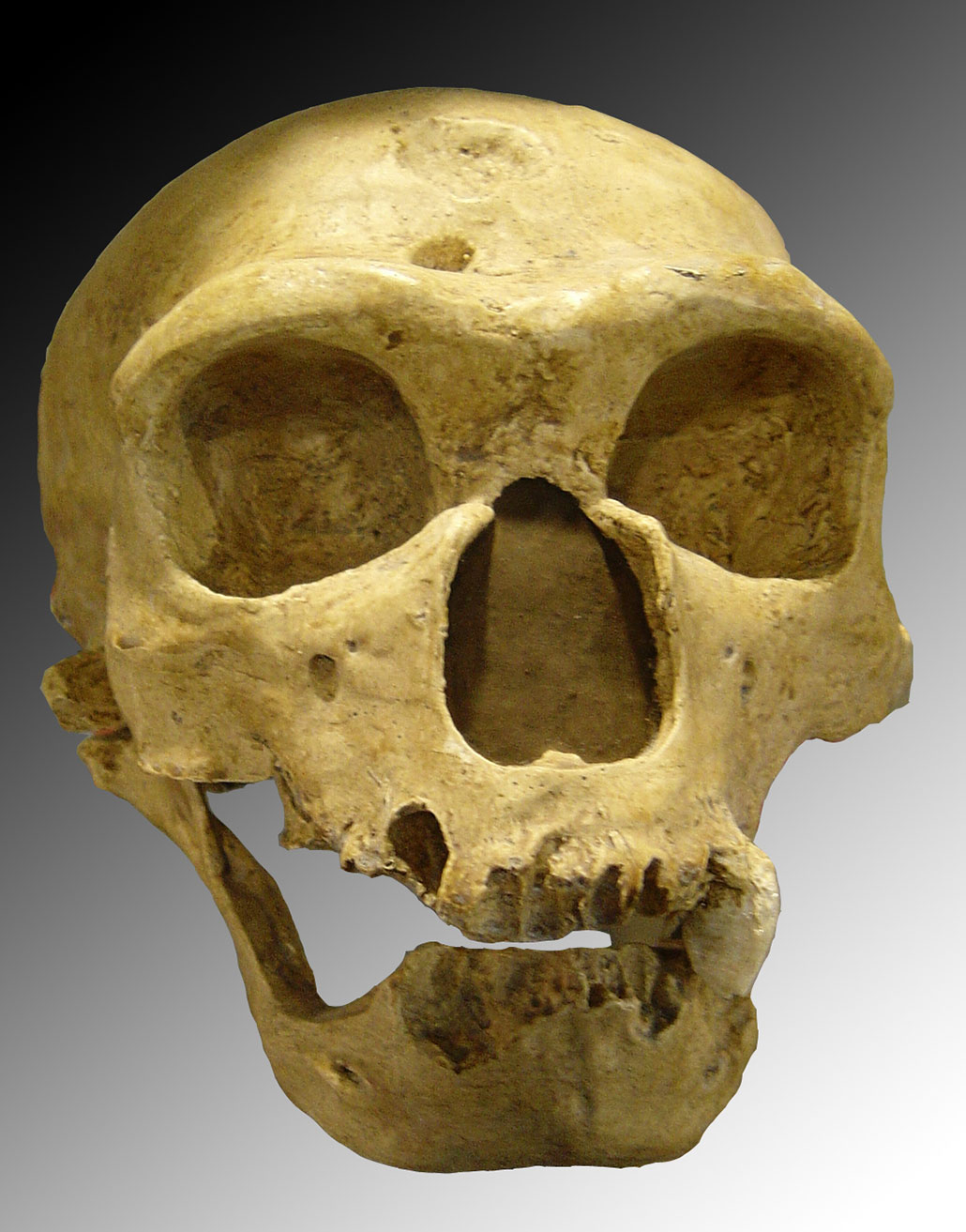 a male Neandertal skull showing missing teeth and damage from gum disease