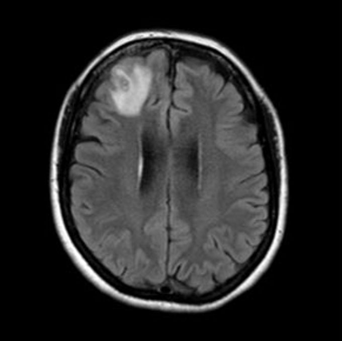An MRI image showing a light gray region of a person's brain.