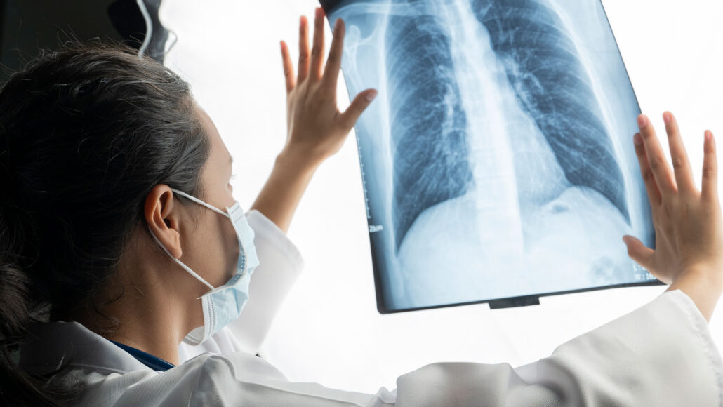 a doctor holds up an X-ray image against a light to observe the image of the interior of a patient's chest