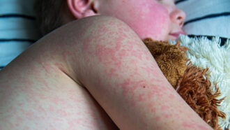 a photo of a measles rash on the torso of a young boy lying in bed