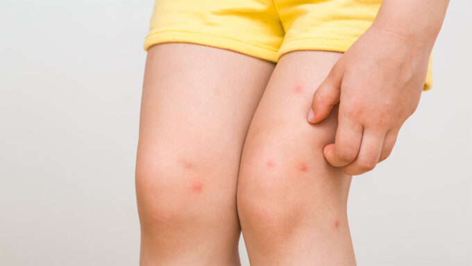 A child's legs have multiple itchy-looking red bug bites that are being scratched.