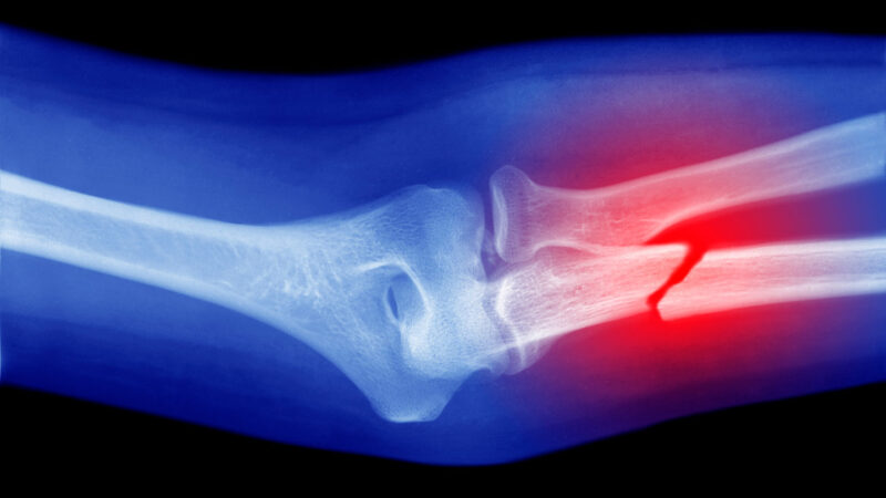 A modified glue gun squirts a material to help heal broken bones