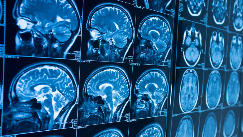 Brain Ripple Activity Brain ‘ripples’ appear just before you remember something