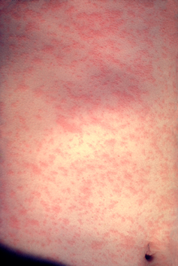 375_CDC_Measles_rash.png