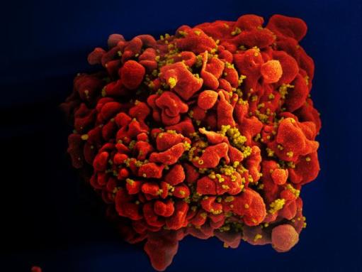 This photo shows HIV infecting a T-cell, which usually fights off infections in the human body. Credit: NIH/NIAID