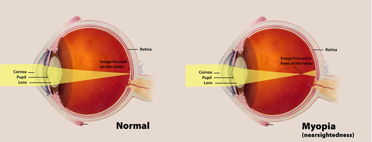 730_SS_myopia_diagram.png