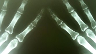 X-rays allow us to see our bones in wonderful detail. But too much exposure can be dangerous. X-rays are a carcinogen, meaning that they can cause cancer.