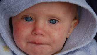 Measles baby