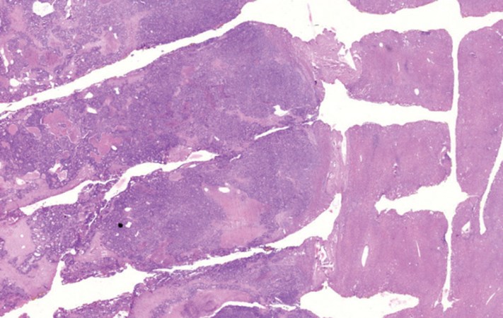 A new electrical device called the iKnife can help surgeons know within seconds if the tissue they’re cutting is healthy or cancerous. This image shows liver tissue with cancer that has spread from another organ. The tissue on the left, which appears to be diagonal in this image, is cancerous. The tissue on the right is healthy. Credit: Science Translational Medicine/AAAS