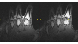 A knuckle at rest (left) pops when pulled. The sound comes from a bubble (right, yellow arrow) opening up in the joint.