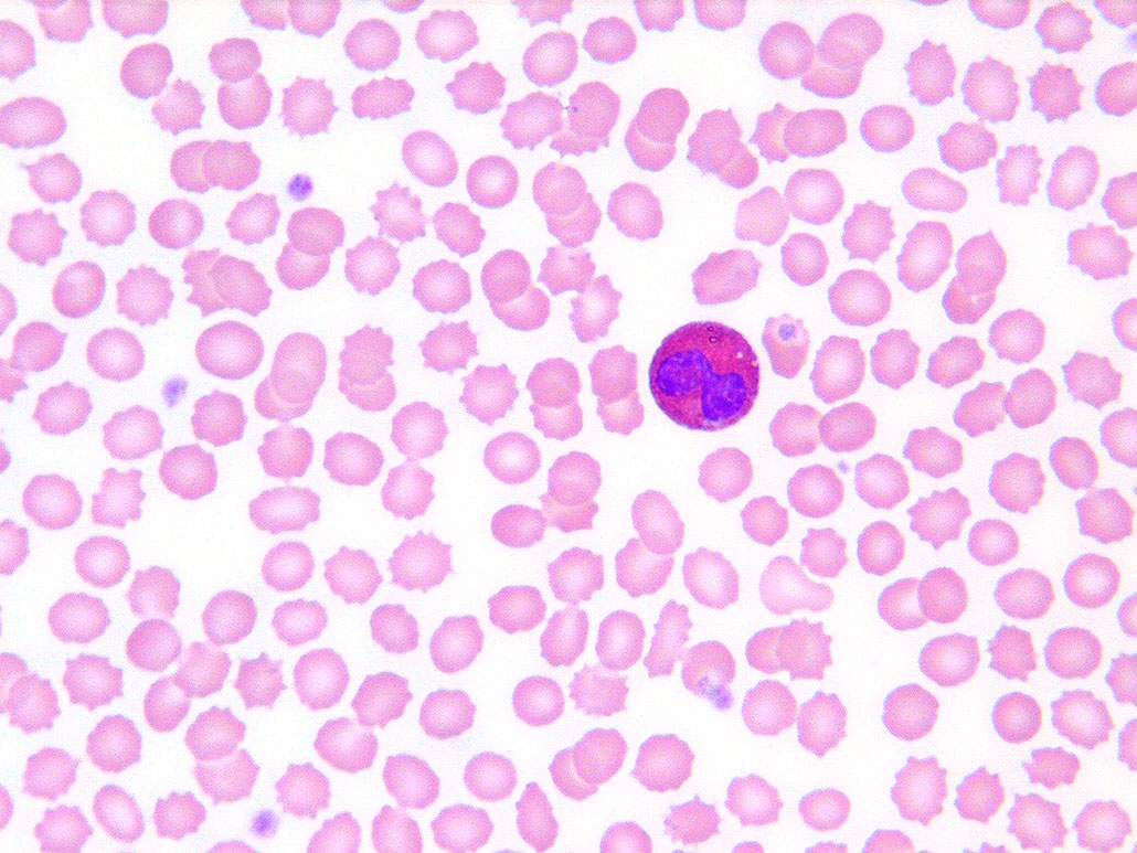 a microscopic image of blood cells, splotchy red blobs and an eosinophil,