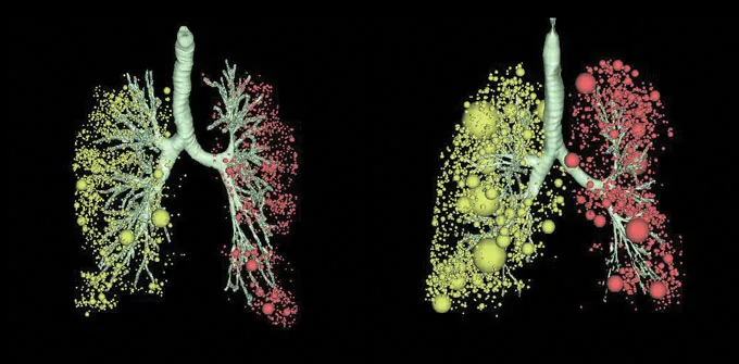two 3D reconstructions of the lungs and their air sacs, showing patterns of damage