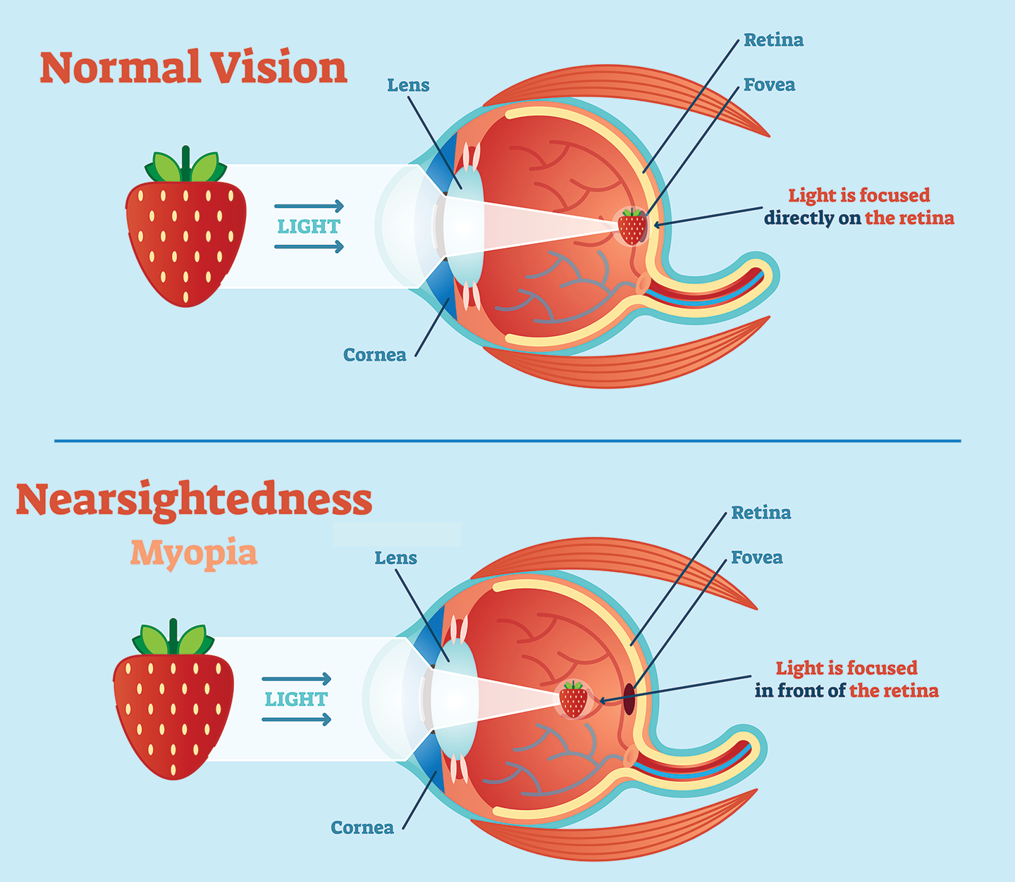 two diagrams shgowing how light enters the eye and where it is focused for normal vision and myopia