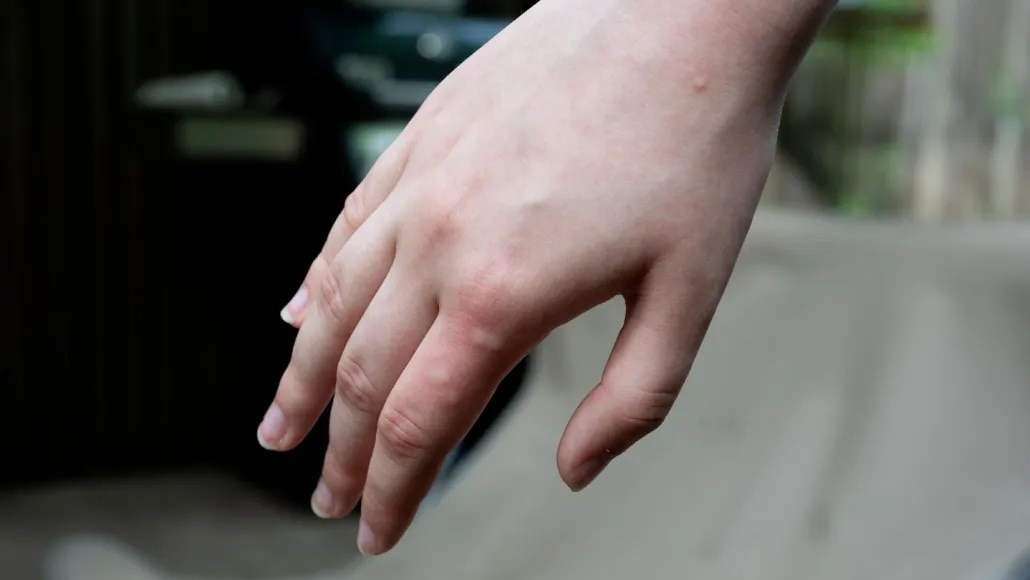 a mosquito-bitten hand